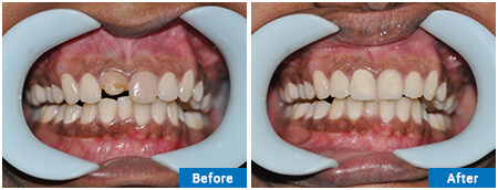 CROWN COLOR & SHAPING